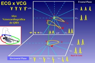 ECG x VCG

Frontal Plane

Alça
Vetorcardiográfica
do QRS

Bayés de Luna

Horizontal Plane

 