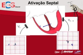 Ativação Septal

1

r

q

 