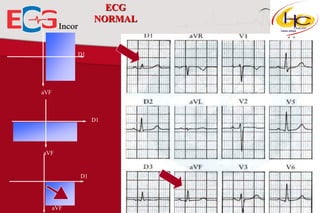 ECG
NORMAL

D1

aVF

D1

aVF

D1

aVF

 