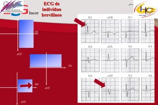 ECG de
indivíduo
brevilíneo

D1

aVF

D1

D1
aVF

aVF

 