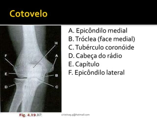 A. Epicôndilo medial 
B. Tróclea (face medial) 
C. Tubérculo coronóide 
D. Cabeça do rádio 
E. Capítulo 
F. Epicôndilo lateral 
RCVM - renatacristina9.9@hotmail.com 
 