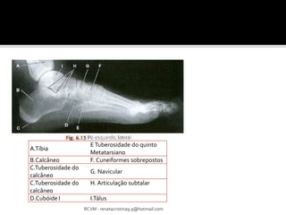 RCVM - renatacristina9.9@hotmail.com 
A.Tíbia 
E Tuberosidade do quinto 
Metatarsiano 
B.Calcâneo F. Cuneiformes sobrepostos 
C.Tuberosidade do 
G. Navicular 
calcâneo 
C.Tuberosidade do 
calcâneo 
H. Articulação subtalar 
D.Cubóide I I.Tálus 
 
