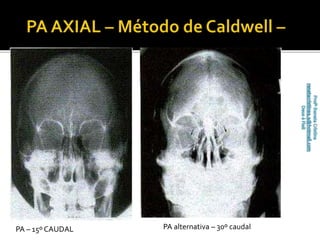 PA – 15º CAUDAL PA alternativa – 30º caudal 
 