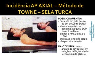 POSICIONAMENTO: 
- Paciente em ortostática 
ou em decúbito Dorsal 
- abaixar o queixo do 
paciente ate que a LOM 
fique  ao filme. 
- alinhar o PMS ao RC e a 
LCM 
- braços ao longo do corpo 
- não permitir rotação 
RAIO CENTRAL: com 
ângulo de 30º caudal em 
relação a LOM, incidindo 
6 cm acima da glabela. 
 