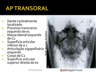 A. Dente centralmente 
localizado 
B. Processo transverso 
esquerdo de e1 
C. Massa lateral esquerda 
de C1 
D. Superfície articular 
inferior de e 1 
E. Articulação zigapofisária 
esquerda 
F. Corpo de C2 
G. Superfície articular 
superior direita de e2 
Profª Renata Cristina 
Profª Renata Cristina 
 