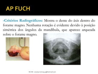 -Critérios Radiográficos: Mostra o dente do áxis dentro do 
forame magno. Nenhuma rotação é evidente devido à posição 
simétrica dos ângulos da mandíbula, que aparece arqueada 
sobre o forame magno. 
RCVM - renatacristina9.9@hotmail.com 
 