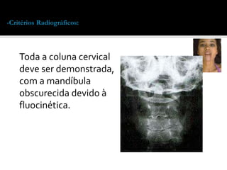 -Critérios Radiográficos: Toda a coluna cervical deve ser demonstrada, com a 
mandíbula obscurecida devido à fluocinética. 
Toda a coluna cervical 
deve ser demonstrada, 
com a mandíbula 
obscurecida devido à 
fluocinética. 
 