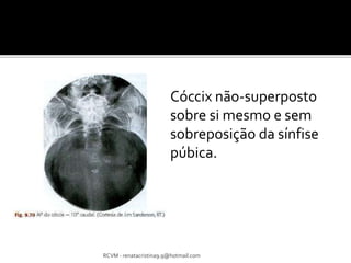 Cóccix não-superposto 
sobre si mesmo e sem 
sobreposição da sínfise 
púbica. 
RCVM - renatacristina9.9@hotmail.com 
 