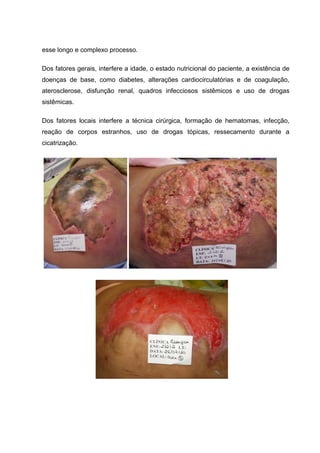 esse longo e complexo processo.
Dos fatores gerais, interfere a idade, o estado nutricional do paciente, a existência de
doenças de base, como diabetes, alterações cardiocirculatórias e de coagulação,
aterosclerose, disfunção renal, quadros infecciosos sistêmicos e uso de drogas
sistêmicas.
Dos fatores locais interfere a técnica cirúrgica, formação de hematomas, infecção,
reação de corpos estranhos, uso de drogas tópicas, ressecamento durante a
cicatrização.
 