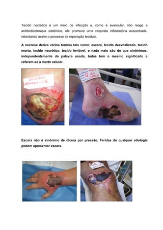 Tecido necrótico é um meio de infecção e, como é avascular, não reage a
antibioticoterapia sistêmica, ele promove uma resposta inflamatória exacerbada,
retardando assim o processo de reparação tecidual.
A necrose deriva vários termos tais como: escara, tecido desvitalizado, tecido
morto, tecido necrótico, tecido inviável, e nada mais são do que sinônimos,
independentemente da palavra usada, todas tem o mesmo significado e
referem-se à morte celular.
Escara não é sinônimo de úlcera por pressão. Feridas de qualquer etiologia
podem apresentar escara.
 
