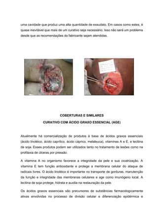 uma cavidade que produz uma alta quantidade de exsudato. Em casos como estes, é
quase inevitável que mais de um curativo seja necessário. Isso não será um problema
desde que as recomendações do fabricante sejam atendidas.
COBERTURAS E SIMILARES
CURATIVO COM ÁCIDO GRAXO ESSENCIAL (AGE)
Atualmente há comercialização de produtos à base de ácidos graxos essenciais
(ácido linoléico, ácido caprílico, ácido cáprico, melaleuca), vitaminas A e E, e lecitina
de soja. Esses produtos podem ser utilizados tanto no tratamento de lesões como na
profilaxia de úlceras por pressão.
A vitamina A no organismo favorece a integridade da pele e sua cicatrização. A
vitamina E tem função antioxidante e protege a membrana celular do ataque de
radicais livres. O ácido linoléico é importante no transporte de gorduras, manutenção
da função e integridade das membranas celulares e age como imunógeno local. A
lecitina de soja protege, hidrata e auxilia na restauração da pele.
Os ácidos graxos essenciais são precursores de substâncias farmacologicamente
ativas envolvidas no processo de divisão celular e diferenciação epidérmica e
 