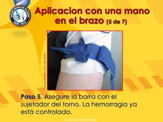 Paso 5. Asegure la barra con el
sujetador del torno. La hemorragia ya
está controlada.
CourtesyofPeterT.Pons,MD,FACEP.
© 2017 de JEL&asociados
 