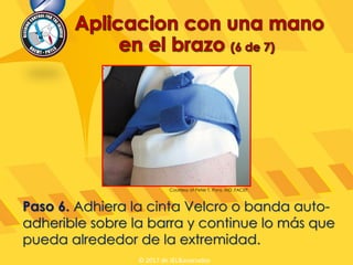 Paso 6. Adhiera la cinta Velcro o banda auto-
adherible sobre la barra y continue lo más que
pueda alrededor de la extremidad.
Courtesy of Peter T. Pons, MD, FACEP.
© 2017 de JEL&asociados
 