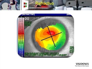 Refractivo
 