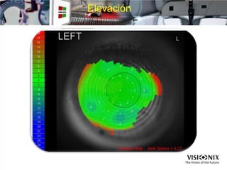 Elevación
 