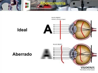 WAVE FRONT
WAVE FRONT
(Similar to a flat sheet of paper)
Ideal
Aberrado
Aberrometría
 