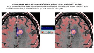 Em casos onde alguns cortes não tem fronteira definida em um setor usar o “Retouch”
Caso o contorno não feche por estar conectado a uma estrutura vizinha, pode-se acionar o modo “Retouch”. Com
isso pode-se criar um traço utilizando o mouse que corta a conexão indesejada.
 