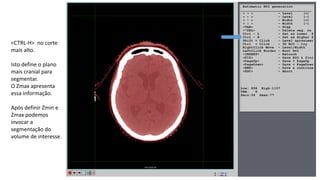 <CTRL-H> no corte
mais alto.
Isto define o plano
mais cranial para
segmentar.
O Zmax apresenta
essa informação.
Após definir Zmin e
Zmax podemos
invocar a
segmentação do
volume de interesse.
 