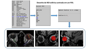 Desenho de ROI esférica centrada em um POI.
 