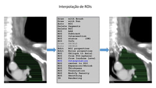 Interpolação de ROIs
 