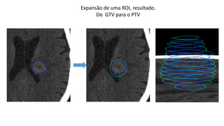 Expansão de uma ROI, resultado.
Do GTV para o PTV
 