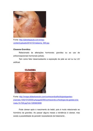 Fonte: http://planetapaula.com.br/wp-
content/uploads/2014/12/melasma_000.jpg
Cloasma Gravídico
Relacionado às alterações hormonais: gravidez ou ao uso de
anticoncepcionais hormonais (pílula).
Tem como fator desencadeante a exposição da pele ao sol ou luz UV
artificial.
Fonte: http://image.slidesharecdn.com/conhecendoafisiologiadagestao-
jniamata-100210120555-phpapp02/95/conhecendo-a-fisiologia-da-gestao-jnia-
mata-10-728.jpg?cb=1265803699
Pode clarear após o nascimento do bebê, pois é muito relacionado ao
hormônio da gravidez. Ao passar alguns meses a tendência é clarear, mas
existe a possibilidade de persistir necessitando de tratamento .
 