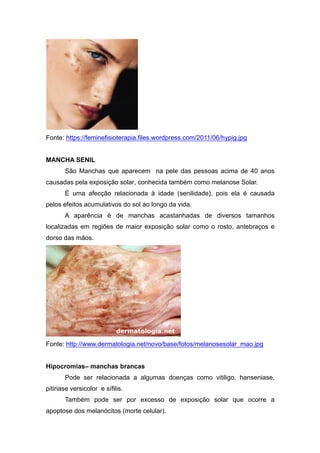 Fonte: https://feminefisioterapia.files.wordpress.com/2011/06/hypig.jpg
MANCHA SENIL
São Manchas que aparecem na pele das pessoas acima de 40 anos
causadas pela exposição solar, conhecida também como melanose Solar.
È uma afecção relacionada à idade (senilidade), pois ela é causada
pelos efeitos acumulativos do sol ao longo da vida.
A aparência é de manchas acastanhadas de diversos tamanhos
localizadas em regiões de maior exposição solar como o rosto, antebraços e
dorso das mãos.
Fonte: http://www.dermatologia.net/novo/base/fotos/melanosesolar_mao.jpg
Hipocromias– manchas brancas
Pode ser relacionada a algumas doenças como vitiligo, hanseniase,
pitiriase versicolor e sífilis.
Também pode ser por excesso de exposição solar que ocorre a
apoptose dos melanócitos (morte celular).
 