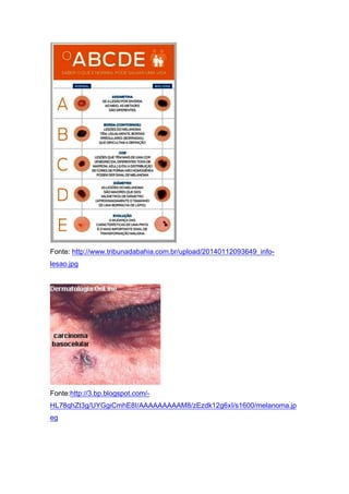 Fonte: http://www.tribunadabahia.com.br/upload/20140112093649_info-
lesao.jpg
Fonte:http://3.bp.blogspot.com/-
HL78qhZt3g/UYGgiCmhE8I/AAAAAAAAAM8/zEzdk12g6xI/s1600/melanoma.jp
eg
 