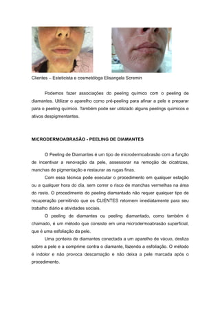 Clientes – Esteticista e cosmetóloga Elisangela Scremin
Podemos fazer associações do peeling químico com o peeling de
diamantes. Utilizar o aparelho como pré-peeling para afinar a pele e preparar
para o peeling químico. Também pode ser utilizado alguns peelings quimicos e
ativos despigmentantes.
MICRODERMOABRASÃO - PEELING DE DIAMANTES
O Peeling de Diamantes é um tipo de microdermoabrasão com a função
de incentivar a renovação da pele, assessorar na remoção de cicatrizes,
manchas de pigmentação e restaurar as rugas finas.
Com essa técnica pode executar o procedimento em qualquer estação
ou a qualquer hora do dia, sem correr o risco de manchas vermelhas na área
do rosto. O procedimento do peeling diamantado não requer qualquer tipo de
recuperação permitindo que os CLIENTES retornem imediatamente para seu
trabalho diário e atividades sociais.
O peeling de diamantes ou peeling diamantado, como também é
chamado, é um método que consiste em uma microdermoabrasão superficial,
que é uma esfoliação da pele.
Uma ponteira de diamantes conectada a um aparelho de vácuo, desliza
sobre a pele e a comprime contra o diamante, fazendo a esfoliação. O método
é indolor e não provoca descamação e não deixa a pele marcada após o
procedimento.
 