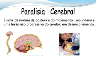 É uma desordem da postura e do movimento , secundária a
uma lesão não progressiva do cérebro em desenvolvimento.
 