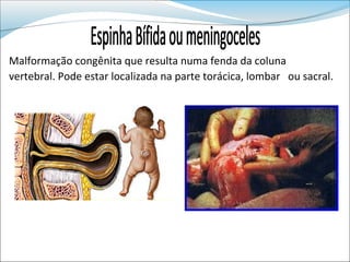 Malformação congênita que resulta numa fenda da coluna
vertebral. Pode estar localizada na parte torácica, lombar ou sacral.
 
