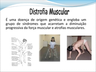 É uma doença de origem genética e engloba um
grupo de síndromes que acarretam a diminuição
progressiva da força muscular e atrofias musculares.
 