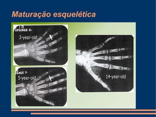 Maturação esquelética
 