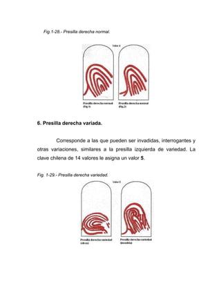Fig.1-28.- Presilla derecha normal.




6. Presilla derecha variada.


          Corresponde a las que pueden ser invadidas, interrogantes y
otras variaciones, similares a la presilla izquierda de variedad. La
clave chilena de 14 valores le asigna un valor 5.


Fig. 1-29.- Presilla derecha variedad.
 