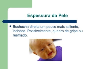 Espessura da Pele
 Bochecha direita um pouco mais saliente,
inchada. Possivelmente, quadro de gripe ou
resfriado.
 