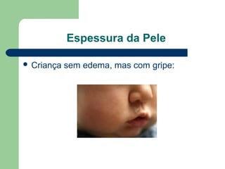 Espessura da Pele
 Criança sem edema, mas com gripe:
 