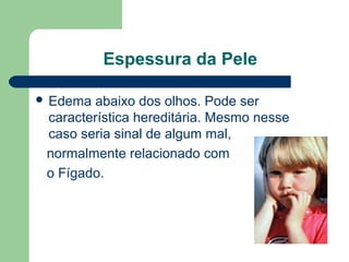 Espessura da Pele
 Edema abaixo dos olhos. Pode ser
característica hereditária. Mesmo nesse
caso seria sinal de algum mal,
normalmente relacionado com
o Fígado.
 