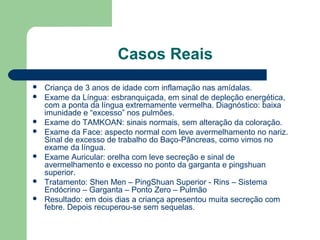 Casos Reais
 Criança de 3 anos de idade com inflamação nas amídalas.
 Exame da Língua: esbranquiçada, em sinal de depleção energética,
com a ponta da língua extremamente vermelha. Diagnóstico: baixa
imunidade e “excesso” nos pulmões.
 Exame do TAMKOAN: sinais normais, sem alteração da coloração.
 Exame da Face: aspecto normal com leve avermelhamento no nariz.
Sinal de excesso de trabalho do Baço-Pâncreas, como vimos no
exame da língua.
 Exame Auricular: orelha com leve secreção e sinal de
avermelhamento e excesso no ponto da garganta e pingshuan
superior.
 Tratamento: Shen Men – PingShuan Superior - Rins – Sistema
Endócrino – Garganta – Ponto Zero – Pulmão
 Resultado: em dois dias a criança apresentou muita secreção com
febre. Depois recuperou-se sem sequelas.
 