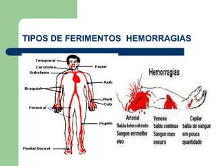 TIPOS DE FERIMENTOS HEMORRAGIAS 
 