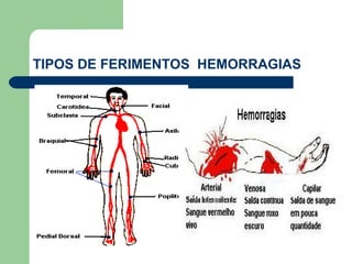 TIPOS DE FERIMENTOS HEMORRAGIAS
 