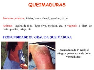 QUEIMADURAS
Produtos químicos: ácidos, bases, álcool, gasolina, etc. e
Animais: lagarta-de-fogo, água-viva, medusa, etc. e vegetais: o látex de
certas plantas, urtiga, etc.
PROFUNDIDADE OU GRAU DA QUEIMADURA
Queimadura de 1º Gral: só
atinge a pele (causando dor e
vermelhidão)
 