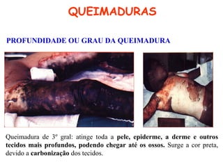 QUEIMADURAS
PROFUNDIDADE OU GRAU DA QUEIMADURA
Queimadura de 3º gral: atinge toda a pele, epiderme, a derme e outros
tecidos mais profundos, podendo chegar até os ossos. Surge a cor preta,
devido a carbonização dos tecidos.
 