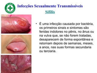 Infecções Sexualmente Transmissíveis
Sífilis
• É uma infecção causada por bactéria,
os primeiros sinais e sintomas são
feridas indolores no pênis, no ânus ou
na vulva que, se não forem tratadas,
desaparecem de forma espontânea e
retornam depois de semanas, meses,
a anos, nas suas formas secundaria
ou terciaria.
 