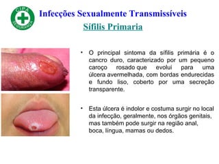 Infecções Sexualmente Transmissíveis
Sífilis Primaria
• O principal sintoma da sífilis primária é o
cancro duro, caracterizado por um pequeno
caroço rosado que evolui para uma
úlcera avermelhada, com bordas endurecidas
e fundo liso, coberto por uma secreção
transparente.
• Esta úlcera é indolor e costuma surgir no local
da infecção, geralmente, nos órgãos genitais,
mas também pode surgir na região anal,
boca, língua, mamas ou dedos.
 
