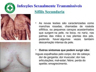 Infecções Sexualmente Transmissíveis
Sífilis Secundaria
• As novas lesões são caracterizadas como
manchas rosadas, chamadas de roséola
sifilítica, ou pequenos caroços acastanhados
que surgem na pele, na boca, no nariz, nas
palmas das mãos e nas plantas dos pés,
podendo haver algumas vezes também
descamação intensa da pele.
• Outros sintomas que podem surgir são:
ínguas espalhadas pelo corpo; dor de cabeça;
dor de garganta; dor muscular; dor nas
articulações; mal-estar; febre; perda do
apetite; emagrecimento.
 