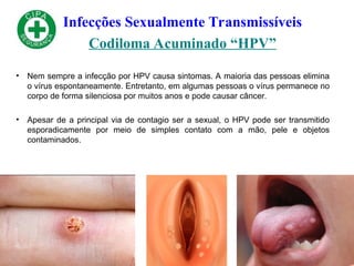 Infecções Sexualmente Transmissíveis
Codiloma Acuminado “HPV”
• Nem sempre a infecção por HPV causa sintomas. A maioria das pessoas elimina
o vírus espontaneamente. Entretanto, em algumas pessoas o vírus permanece no
corpo de forma silenciosa por muitos anos e pode causar câncer.
• Apesar de a principal via de contagio ser a sexual, o HPV pode ser transmitido
esporadicamente por meio de simples contato com a mão, pele e objetos
contaminados.
 