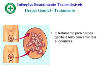 Infecções Sexualmente Transmissíveis
Herpes Genital - Tratamento
• O tratamento para herpes
genital é feito com antivirais
e pomadas.
 