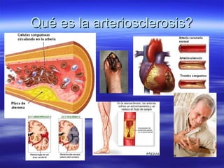 Qué es la arteriosclerosis?
 