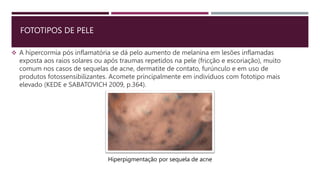 FOTOTIPOS DE PELE
 A hipercormia pós inflamatória se dá pelo aumento de melanina em lesões inflamadas
exposta aos raios solares ou após traumas repetidos na pele (fricção e escoriação), muito
comum nos casos de sequelas de acne, dermatite de contato, furúnculo e em uso de
produtos fotossensibilizantes. Acomete principalmente em indivíduos com fototipo mais
elevado (KEDE e SABATOVICH 2009, p.364).
Hiperpigmentação por sequela de acne
 