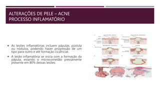 ALTERAÇÕES DE PELE – ACNE
PROCESSO INFLAMATÓRIO
 As lesões inflamatórias incluem pápulas, pústula
ou nódulos, podendo haver progressão de um
tipo para outro e até formação cicatricial.
 A lesão inflamatória se inicia com a formação da
pápula, estando o microcomedão previamente
presente em 80% dessas lesões.
 